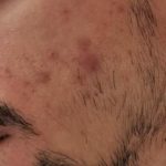⁦Differin, جل Adapalene 0.1%، علاج حب الشباب، 0.5 أوقية (15 غ)⁩ - الصورة ⁦3⁩
